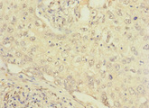 FCRL2 / IRTA4 Antibody - Immunohistochemistry of paraffin-embedded human lung cancer at dilution 1:100