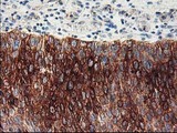 FDFT1 / Squalene Synthase Antibody - IHC of paraffin-embedded Carcinoma of Human bladder tissue using anti-FDFT1 mouse monoclonal antibody.