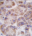 FDPS Antibody - Formalin-fixed and paraffin-embedded human hepatocarcinoma tissue reacted with FDPS antibody (Center ), which was peroxidase-conjugated to the secondary antibody, followed by DAB staining. This data demonstrates the use of this antibody for immunohistochemistry; clinical relevance has not been evaluated.