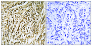 FEN1 Antibody - Immunohistochemistry analysis of paraffin-embedded human breast carcinoma tissue, using FEN1 Antibody. The picture on the right is blocked with the synthesized peptide.