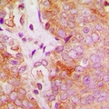 FES Antibody - Immunohistochemical analysis of c-FER staining in human breast cancer formalin fixed paraffin embedded tissue section. The section was pre-treated using heat mediated antigen retrieval with sodium citrate buffer (pH 6.0). The section was then incubated with the antibody at room temperature and detected with HRP and DAB as chromogen. The section was then counterstained with hematoxylin and mounted with DPX.