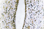 FES Antibody - IHC of Fes (K161) pAb in paraffin-embedded human liver carcinoma tissue.