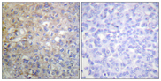 FGFR1 / FGF Receptor 1 Antibody - Immunohistochemistry analysis of paraffin-embedded human breast carcinoma tissue, using FGFR1 Antibody. The picture on the right is blocked with the synthesized peptide.