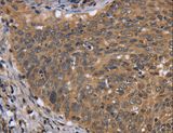 FGFR1OP / FOP Antibody - Immunohistochemistry of paraffin-embedded Human cervical cancer using FGFR1OP Polyclonal Antibody at dilution of 1:40.