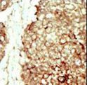 FGFR2 / FGF Receptor 2 Antibody - Formalin-fixed and paraffin-embedded human cancer tissue reacted with the primary antibody, which was peroxidase-conjugated to the secondary antibody, followed by DAB staining. This data demonstrates the use of this antibody for immunohistochemistry; clinical relevance has not been evaluated. BC = breast carcinoma; HC = hepatocarcinoma.
