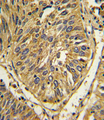 FGFR2 / FGF Receptor 2 Antibody - Formalin-fixed and paraffin-embedded human lung carcinoma with FGFR2 Antibody, which was peroxidase-conjugated to the secondary antibody, followed by DAB staining. This data demonstrates the use of this antibody for immunohistochemistry; clinical relevance has not been evaluated.