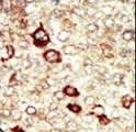 FGFR4 Antibody - Formalin-fixed and paraffin-embedded human cancer tissue reacted with the primary antibody, which was peroxidase-conjugated to the secondary antibody, followed by AEC staining. This data demonstrates the use of this antibody for immunohistochemistry; clinical relevance has not been evaluated. BC = breast carcinoma; HC = hepatocarcinoma.