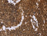 FGFRL1 Antibody - Immunohistochemistry of paraffin-embedded Human cervical cancer using FGFRL1 Polyclonal Antibody at dilution of 1:40.