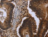 FHL3 Antibody - Immunohistochemistry of paraffin-embedded Human colon cancer using FHL3 Polyclonal Antibody at dilution of 1:40.