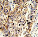 Fibulin-3 / EFEMP1 Antibody - Formalin-fixed and paraffin-embedded human lung carcinoma reacted with EFEMP1 Antibody , which was peroxidase-conjugated to the secondary antibody, followed by DAB staining. This data demonstrates the use of this antibody for immunohistochemistry; clinical relevance has not been evaluated.