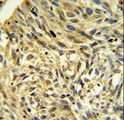 FKBP14 Antibody - FKBP14 Antibody IHC of formalin-fixed and paraffin-embedded human Lung carcinoma followed by peroxidase-conjugated secondary antibody and DAB staining.