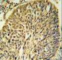 FKBP9 Antibody - FKBP9 Antibody IHC of formalin-fixed and paraffin-embedded human Lung carcinoma followed by peroxidase-conjugated secondary antibody and DAB staining.