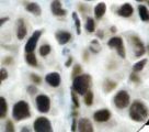 FLI1 Antibody - IHC of Fli-1 on FFPE Renal Cell Carcinoma tissue. This image was taken for the unmodified form of this product. Other forms have not been tested.