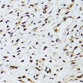 FLI1 Antibody - Immunohistochemistry of paraffin-embedded human uterine cancer tissue.
