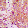 FLNA / Filamin A Antibody - Immunohistochemical analysis of Filamin A staining in human breast cancer formalin fixed paraffin embedded tissue section. The section was pre-treated using heat mediated antigen retrieval with sodium citrate buffer (pH 6.0). The section was then incubated with the antibody at room temperature and detected using an HRP conjugated compact polymer system. DAB was used as the chromogen. The section was then counterstained with hematoxylin and mounted with DPX.
