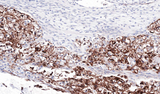 FLRT1 Antibody - IHC of paraffin-embedded OVCA using FLRT1 antibody at 1:100 dilution.
