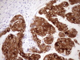 FMO3 Antibody - IHC of paraffin-embedded Carcinoma of Human liver tissue using anti-FMO3 mouse monoclonal antibody. (Heat-induced epitope retrieval by Tris-EDTA, pH8.0)(1:150).