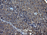FNDC8 Antibody - IHC of paraffin-embedded Adenocarcinoma of Human endometrium tissue using anti-FNDC8 mouse monoclonal antibody. (Heat-induced epitope retrieval by 1 mM EDTA in 10mM Tris, pH8.5, 120°C for 3min).