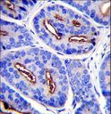 FOLH1 / PSMA Antibody - FOLH1 Antibody immunohistochemistry of formalin-fixed and paraffin-embedded human prostate carcinoma followed by peroxidase-conjugated secondary antibody and DAB staining.