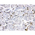 FOSB Antibody - Fos B antibody IHC-paraffin. IHC(P): Human Pancreatic Cancer Tissue.