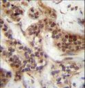 FOXA2 Antibody - FOXA2 Antibody (Center T156) immunohistochemistry of formalin-fixed and paraffin-embedded human bladder carcinoma followed by peroxidase-conjugated secondary antibody and DAB staining.
