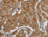FOXF2 Antibody - Immunohistochemistry of paraffin-embedded Human breast cancer using FOXF2 Polyclonal Antibody at dilution of 1:30.