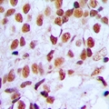 FOXK1 / MNF Antibody - Immunohistochemical analysis of FOXK1 staining in human breast cancer formalin fixed paraffin embedded tissue section. The section was pre-treated using heat mediated antigen retrieval with sodium citrate buffer (pH 6.0). The section was then incubated with the antibody at room temperature and detected with HRP and DAB as chromogen. The section was then counterstained with hematoxylin and mounted with DPX.