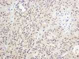 FOXO1 / FKHR Antibody - Detection of Human FOXO1a by Immunohistochemistry. Sample: FFPE section of human ovarian carcinoma. Antibody: Affinity purified rabbit anti-FOXO1a used at a dilution of 1:500 (2 ug/ml). Detection: DAB.