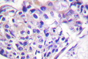 FOXO1 / FKHR Antibody - IHC of p-FOXO1A (S329) pAb in paraffin-embedded human breast carcinoma tissue.