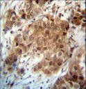 FOXO3 / FOXO3A Antibody - FOXO3 Antibody immunohistochemistry of formalin-fixed and paraffin-embedded human breast carcinoma followed by peroxidase-conjugated secondary antibody and DAB staining.