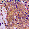 FOXO4 / AFX1 Antibody - Immunohistochemical analysis of FOXO4 staining in human breast cancer formalin fixed paraffin embedded tissue section. The section was pre-treated using heat mediated antigen retrieval with sodium citrate buffer (pH 6.0). The section was then incubated with the antibody at room temperature and detected using an HRP conjugated compact polymer system. DAB was used as the chromogen. The section was then counterstained with hematoxylin and mounted with DPX.