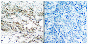 FOXO4 / AFX1 Antibody - Immunohistochemistry analysis of paraffin-embedded human breast carcinoma, using AFX (Phospho-Ser197) Antibody. The picture on the right is blocked with the phospho peptide.