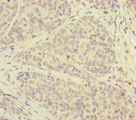 FOXRED1 Antibody - Immunohistochemistry of paraffin-embedded human ovarian cancer at dilution of 1:100