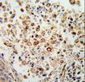FPR3 / FPRL2 Antibody - Formalin-fixed and paraffin-embedded human lung carcinoma reacted with FPRL2 Antibody , which was peroxidase-conjugated to the secondary antibody, followed by DAB staining. This data demonstrates the use of this antibody for immunohistochemistry; clinical relevance has not been evaluated.
