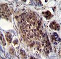 FRAT2 Antibody - FRAT2 Antibody immunohistochemistry of formalin-fixed and paraffin-embedded human bladder carcinoma followed by peroxidase-conjugated secondary antibody and DAB staining.