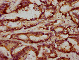 FRMD6 Antibody - IHC image of FRMD6 Antibody diluted at 1:293 and staining in paraffin-embedded human colon cancer performed on a Leica BondTM system. After dewaxing and hydration, antigen retrieval was mediated by high pressure in a citrate buffer (pH 6.0). Section was blocked with 10% normal goat serum 30min at RT. Then primary antibody (1% BSA) was incubated at 4°C overnight. The primary is detected by a biotinylated secondary antibody and visualized using an HRP conjugated SP system.