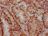 FRMD7 Antibody - Immunohistochemistry Dilution at 1:400 and staining in paraffin-embedded human prostate cancer performed on a Leica BondTM system. After dewaxing and hydration, antigen retrieval was mediated by high pressure in a citrate buffer (pH 6.0). Section was blocked with 10% normal Goat serum 30min at RT. Then primary antibody (1% BSA) was incubated at 4°C overnight. The primary is detected by a biotinylated Secondary antibody and visualized using an HRP conjugated SP system.