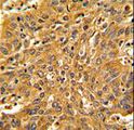 FSCN1 / Fascin Antibody - Formalin-fixed and paraffin-embedded human lung carcinoma with Fascin Antibody , which was peroxidase-conjugated to the secondary antibody, followed by DAB staining. This data demonstrates the use of this antibody for immunohistochemistry; clinical relevance has not been evaluated.