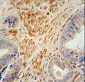 FSTL1 Antibody - FSTL1 antibody immunohistochemistry of formalin-fixed and paraffin-embedded human prostate carcinoma followed by peroxidase-conjugated secondary antibody and DAB staining.