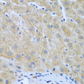 FURIN Antibody - Immunohistochemistry of paraffin-embedded human liver cancer tissue.