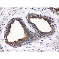 FUT1 / HSC Antibody - FUT1 antibody IHC-paraffin. IHC(P): Human Mammary Cancer Tissue.