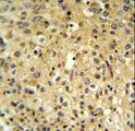FYTTD1 Antibody - FYTD1 Antibody IHC of formalin-fixed and paraffin-embedded human cervix carcinoma followed by peroxidase-conjugated secondary antibody and DAB staining.