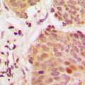 G3BP1 / G3BP Antibody - Immunohistochemical analysis of G3BP1 staining in human breast cancer formalin fixed paraffin embedded tissue section. The section was pre-treated using heat mediated antigen retrieval with sodium citrate buffer (pH 6.0). The section was then incubated with the antibody at room temperature and detected using an HRP conjugated compact polymer system. DAB was used as the chromogen. The section was then counterstained with hematoxylin and mounted with DPX.