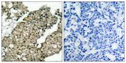 G3BP1 / G3BP Antibody - P-Peptide - + Immunohistochemical analysis of paraffin-embedded human breast carcinoma tissue using G3BP-1 (phospho-Ser232) antibody.