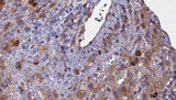 GABRA2 Antibody - 1:100 staining human liver carcinoma tissues by IHC-P. The sample was formaldehyde fixed and a heat mediated antigen retrieval step in citrate buffer was performed. The sample was then blocked and incubated with the antibody for 1.5 hours at 22°C. An HRP conjugated goat anti-rabbit antibody was used as the secondary.