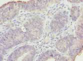 GAJ / MND1 Antibody - Immunohistochemistry of paraffin-embedded human endometrial cancer using antibody at dilution of 1:100.