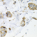 GALC / Galactocerebrosidase Antibody - Immunohistochemistry of paraffin-embedded human gastric cancer tissue.