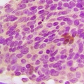 GALC / Galactocerebrosidase Antibody - Human Breast carcinoma, FFPE