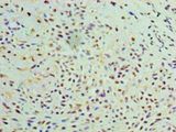 GALE / UDP-Glucose 4-Epimerase Antibody - Immunohistochemistry of paraffin-embedded human breast cancer using antibody at 1:100 dilution.  This image was taken for the unconjugated form of this product. Other forms have not been tested.