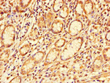 GALNT11 Antibody - Immunohistochemistry of paraffin-embedded human gastric cancer at dilution of 1:100